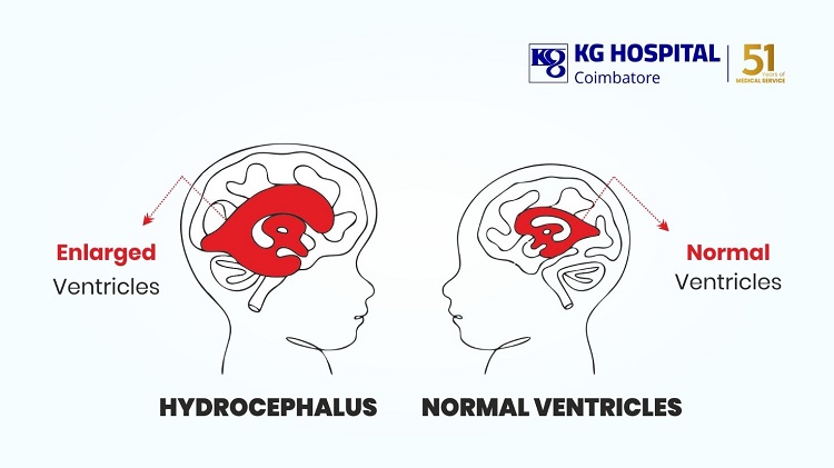 Hydrocephalus
