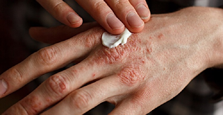 Eczema Treatment